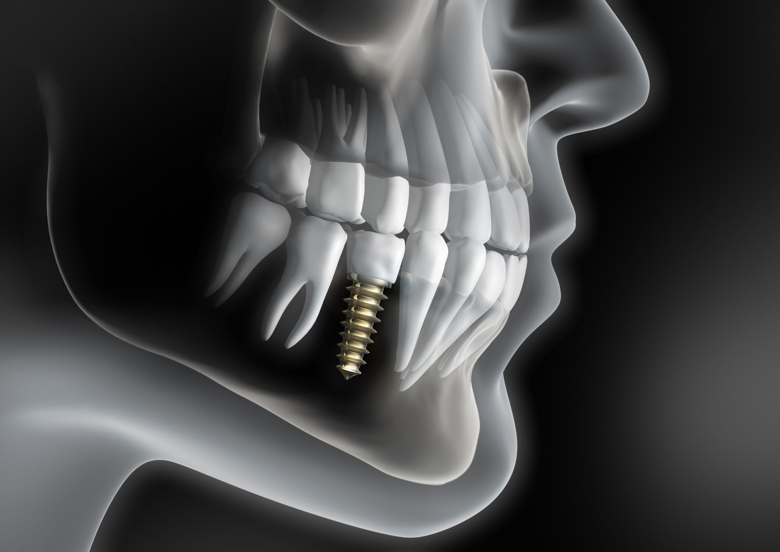 implantes dentales e implantología maxilofacial en madrid implantes dentales e implantología maxilofacial en madrid