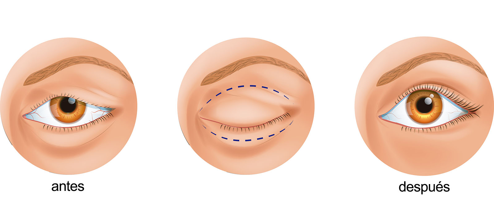 Blefaroplastia