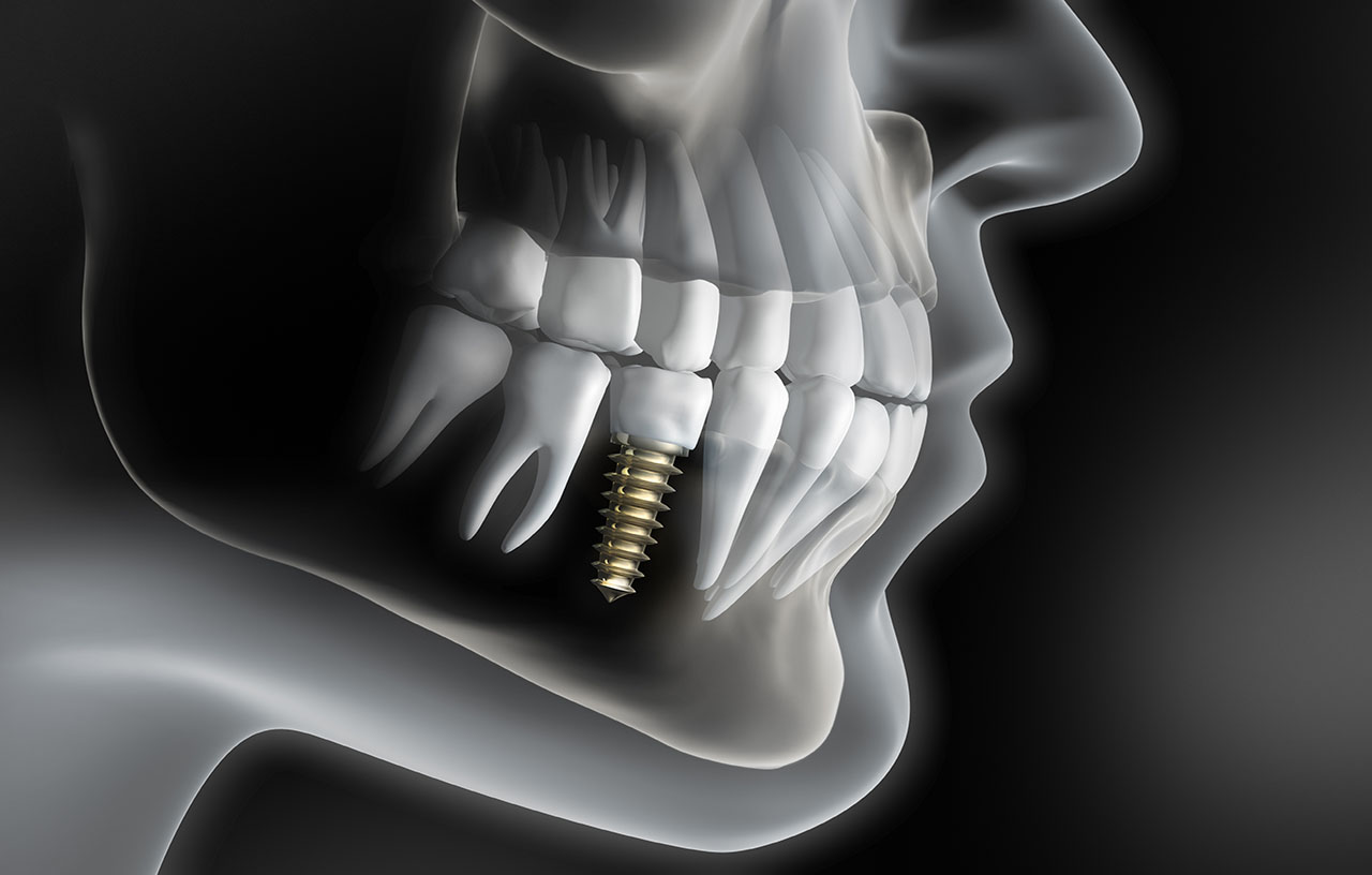 implantes dentales implantes dentales
