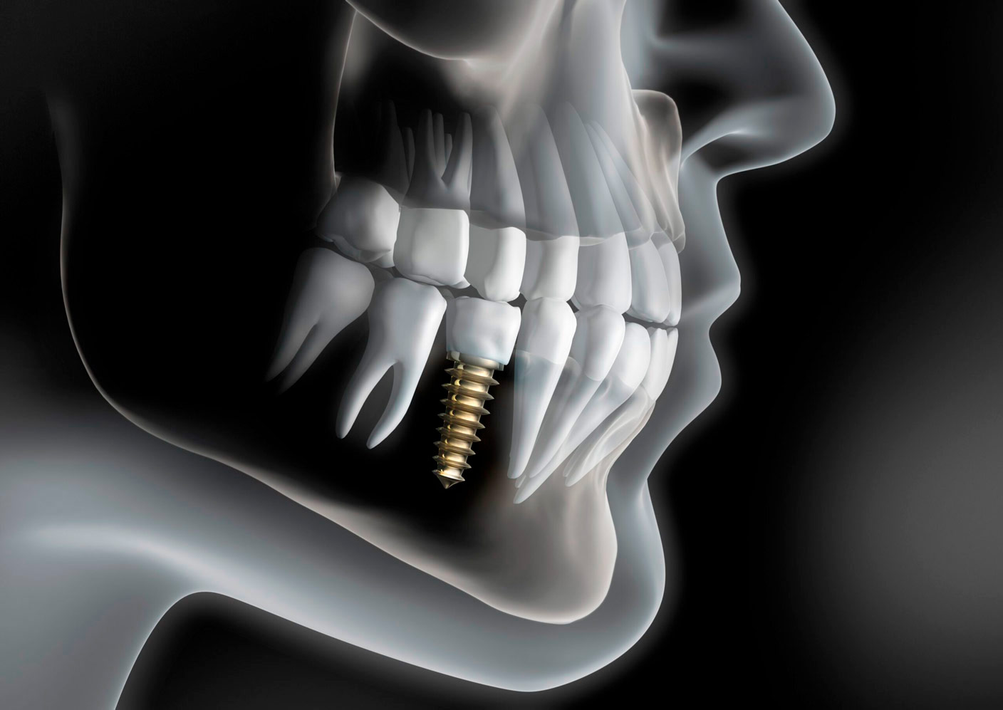 implantes dentales e implantología maxilofacial en madrid
